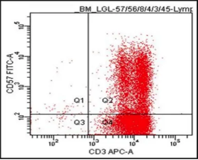 Figure 1: Flow cytometry on bone marrow cells. Majority of cells are CD3+CD57+, a feature of T‑LGL.