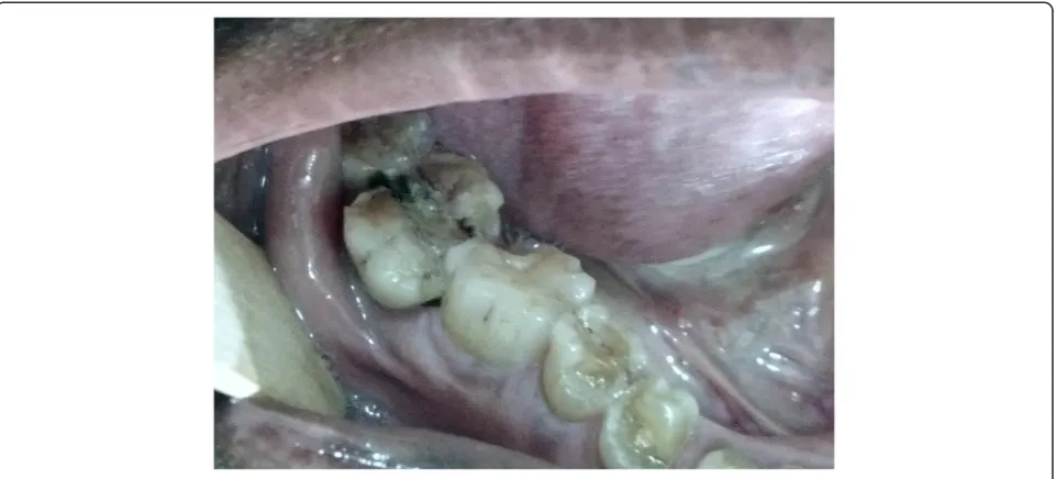 Figure 2 Split tooth with periodontal abscess.