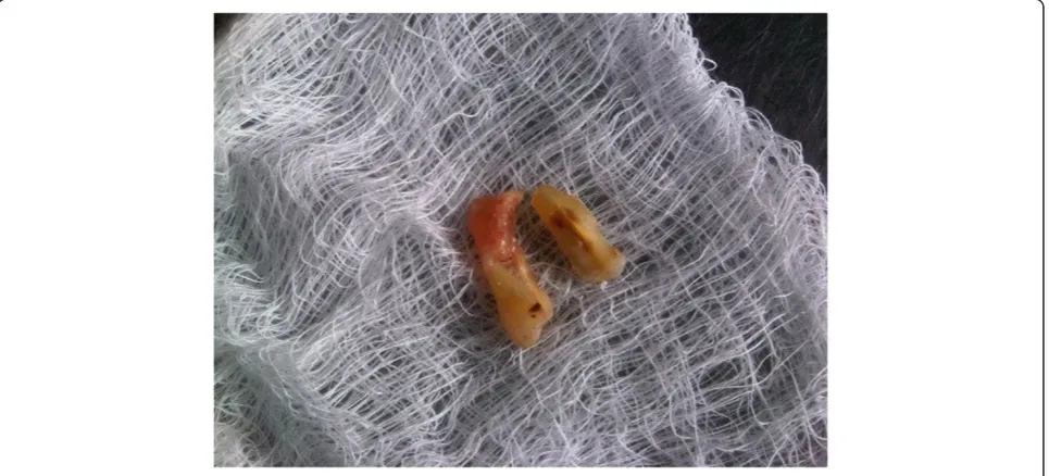 Figure 3 Fractured cusp.