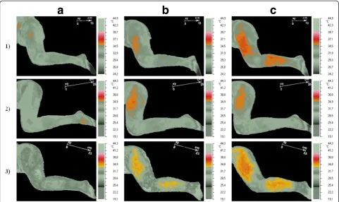 Figure 2 Visualization of the highest temperature reaction measured on the skin surface (short-term vasodilation effect).depict the area of vasodilation, pre-DN patient temperature reaction has been isolated In order to – grey pictures column (a)