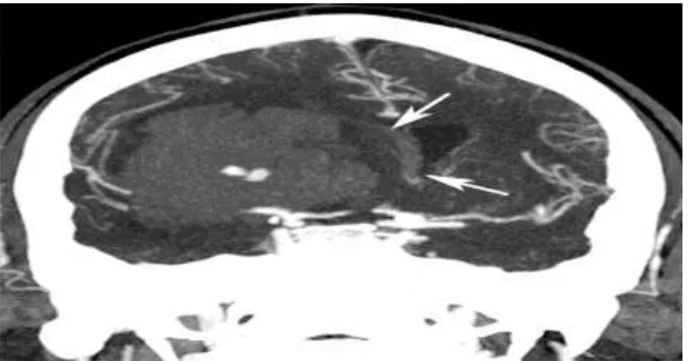 Fig.1: Hypertensive intraparenchymal hematoma with subfalcine herniation. Coronal  two-dimensional reconstruction from a computed tomography angiogram demonstrates transfalcine herniation (arrows) to the left due to large right sided intraparenchymal hemorrhage.[15] 