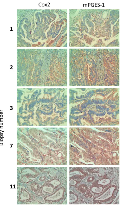 Figure 2: COX2 and mPGES1 expression in human colorectal tumor biopsies. Samples from colorectal tumors were processed for immunohistochemistry using antibodies specific for COX2 and mPGES1