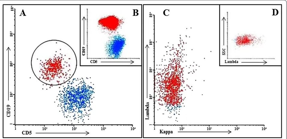 Figure 1 Cerebrospinal fluid and peripheral blood immunophenotyping: flow cytometric dot plots of cerebrospinal fluid (A, C and D)and peripheral blood (B) demonstrating CLL populations