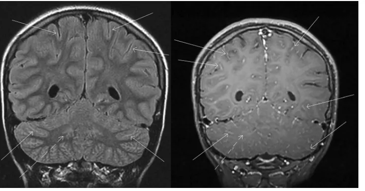 FIG 1 MRI ﬁndings suggestive of infectious meningoencephalitis. Coronal FLAIR (left) and postcontrast T1 (right)magnetic resonance imaging show subtle signs of inﬂammation, including hyperintense signal along multiplecerebral gyri and contrast enhancement 