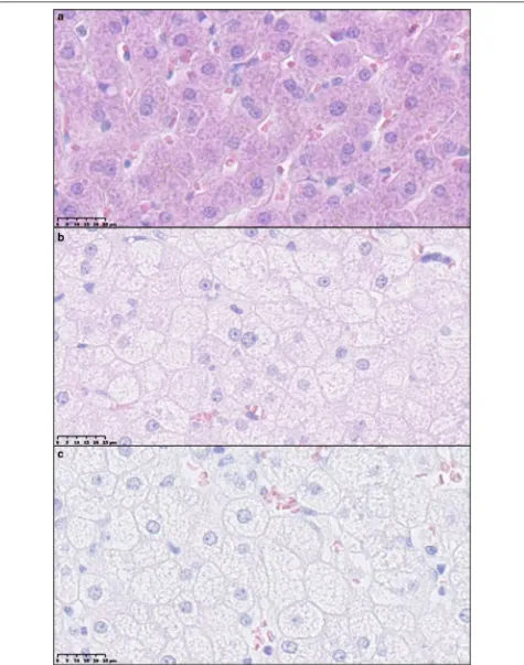 Fig. 5 Examples of cytoplasmic alterations in hepatocytes characterized by hepatocytes with pale, granular appearance