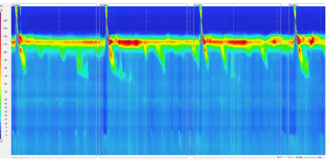 Figure 3. Absent contractility. Aperistalsis in the setting of normal LES relaxation (IRP < 10 mmHg)