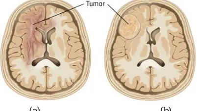 Fig. 1 (a) malignant brain tumor; (b) Benign brain tumor 