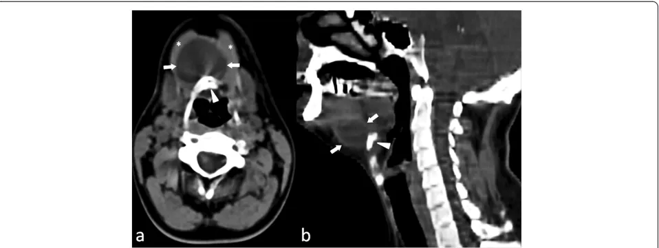 Figure 3 Axial (a) and sagittal (b) unenhanced computed tomography scans show the presence of a hypodense round mass (3 × 4 cm)(arrows) with a fluid density value (mean density = 20 HU) located medially and in front of the hyoid bone (arrowhead).