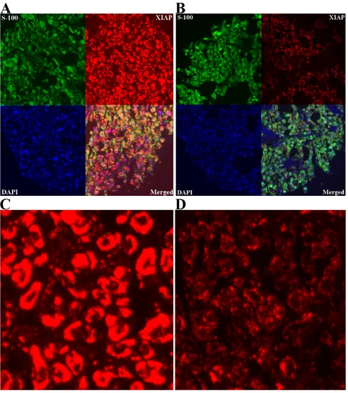 Figure 2Strong (A) and weak (B) XIAP expression (red) in melanoma using ×10 magnification, employing S100 (green) to define tumor and DAPI (blue) to define nuclei