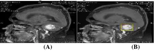 Figure 31Tumor detection in Meningioma Types Image 