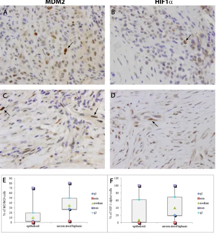 Figure 2: MDM2 strong nuclear immunostaining in tumor samples from epithelioid and sarcomatoid/biphasic mesothelioma