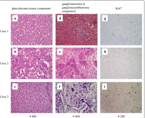 Figure 2 Microscopic findings of resected tumors. Left lanes (a–c) pheochromocytoma component (hematoxylin and eosin staining, ×400)