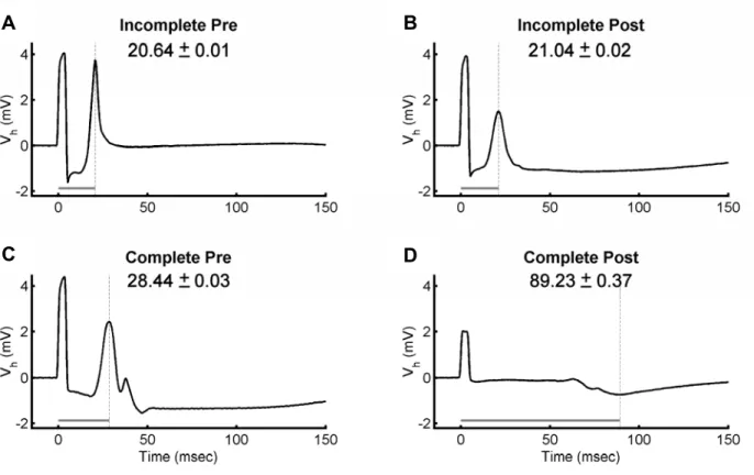Figure 2.3  Electrograms for incomplete and complete lesions. The electrograms in Row I were recorded  before (A) and after (B) an incomplete ablation