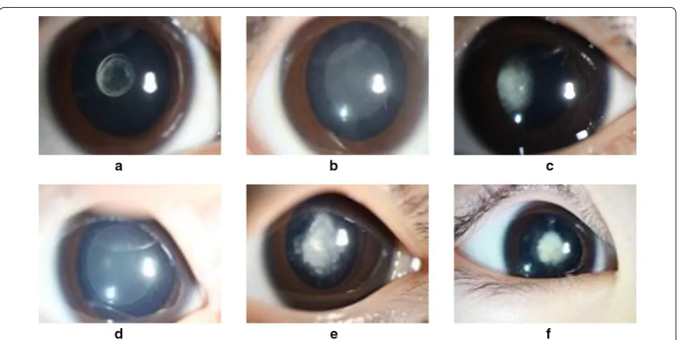 Fig. 1 Three grading standards of severity of pediatric cataracts. cataract is sloppy; a the area of cataract is small; b the area of cataract is large; c the density of the d the density of the cataract is dense; e the cataract covers the central area of lens; f the cataract does not covering the central area of lens