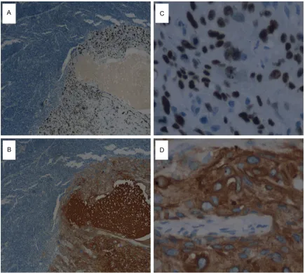 Figure 3. Immunoreactivity in SqCC component. Positivity of P40 and CK5/6 indicate SqCC component (A, B, ×40)