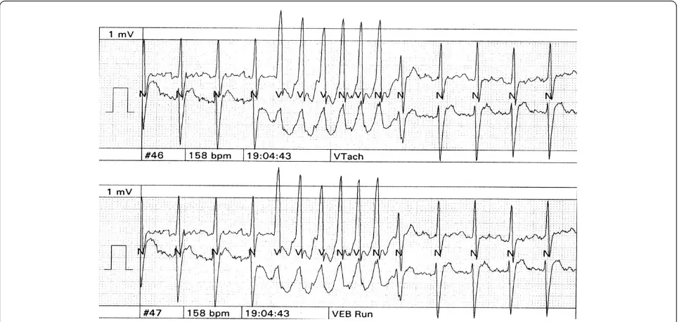 Figure 3 A transthoracic echocardiography showed a mildly dilated left ventricular with severe global left ventricular systolic dysfunctionwith an estimated left ventricular ejection fraction of 20 to 25%.