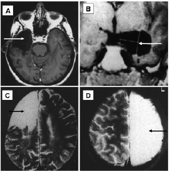 Figure 1-1. Different Types of Epilepsy Surgery (modified from Siegel 2003). 