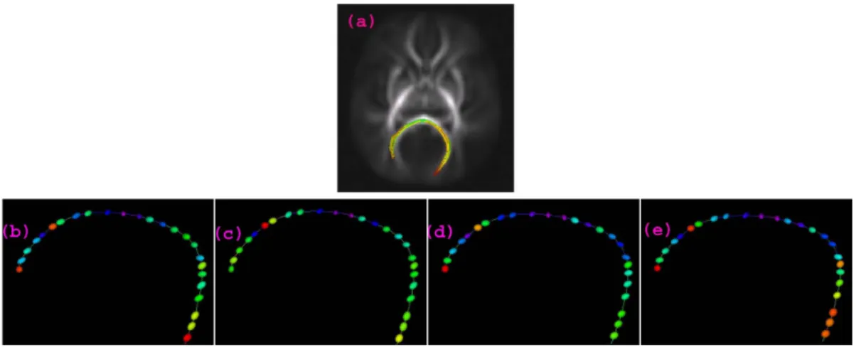 Figure 1.1 (a) displays one fiber tract in the brain, called the splenium tract projected onto a slice of the FA image from a DTI scan