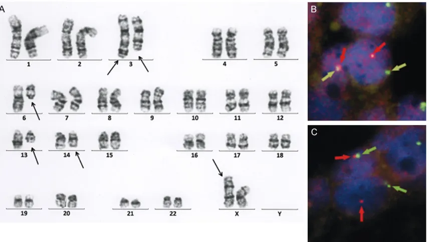 Figure 2. G-banded karyogram obtained in this case. The arrows show derivative chromosomes (A)