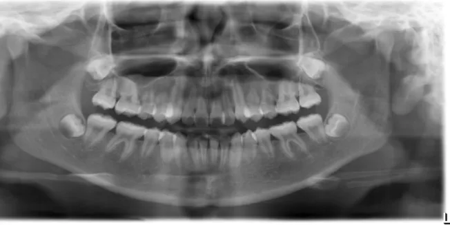 Figure 4: Panoramic radiograph of 13 yr. old Hispanic female with maxillary central incisors, mandibular  and maxillary premolars affected (Type 2 SRA)