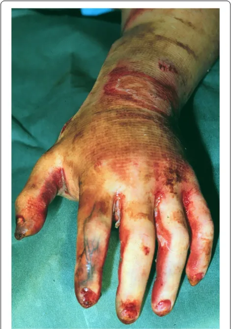 Figure 2 Third degree burns (Note the thrombotic vesselsformation).