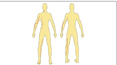 Figure 3 Escharotomy lines: Example of typical ways to incise the eschar. Note that the incisions should be made horizontally whencrossing a joint.