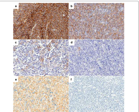 Fig. 1 Immunohistochemical expression patterns of PD‑L1 and pSTAT3 in diffuse large B cell lymphoma