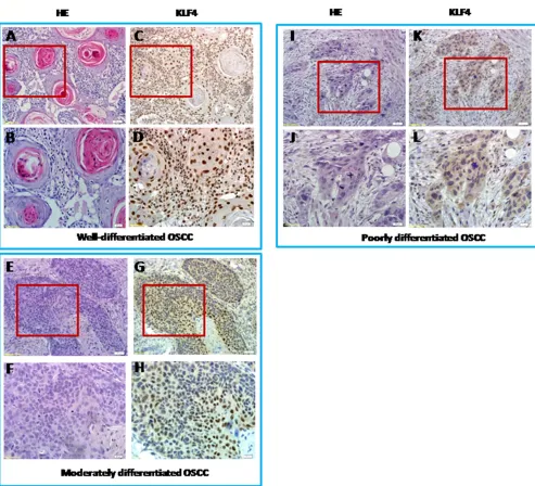 Figure 2: KLF4 expression in different grades of human oral squamous cell carcinomas by IHC and H&E pictures of equivalent from KLF4 pictures with low magnification and high magnification of the sample