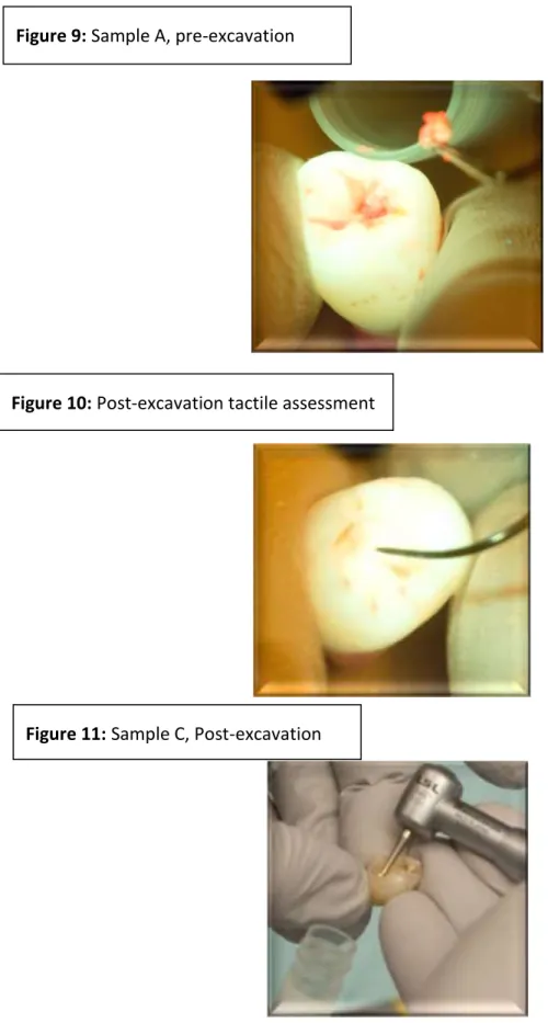Figure 10: Post-excavation tactile assessment 
