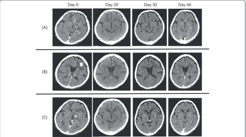 Figure 5 Cranial computed tomography scan after the withdrawal of methotrexate. The masses of (A) right frontal lobe, (B) left frontallobe, and (C) left nucleus basalis were gradually reduced.