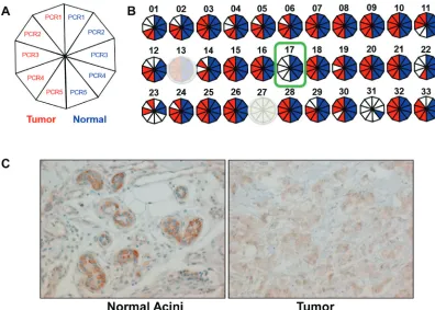 Figure 1: clonal loss of the Y chromosome in male breast cancer. FISH was performed to evaluate Y and X chromosomes on a male breast cancer tissue sample from a patient with clonal Y loss (top panels), normal breast tissue from the same patient as a somati