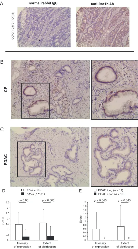 Figure 1: Immunohistochemical detection and quantification of Rac1b expression in CP and PDAC