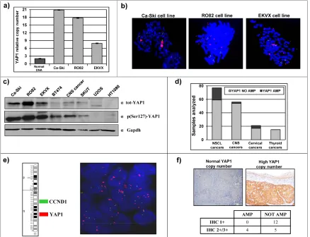 Figure 1: Identification of cancer cell lines and clinical cancer samples carrying 11q22 amplification and overexpression