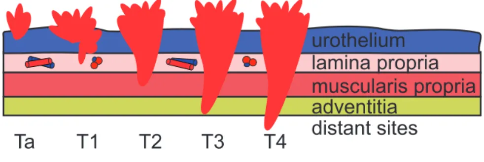Figure 2: Bladder cancer staging 