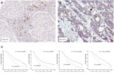 Figure 2: Lambda FLCs are found co-localized to regions of inflammation in breast tumors and their presence predicts worse breast cancer prognosis.(A) Using immunohistochemistry Lambda FLC was found localized to inflammatory cells located close to medullary breast cancer cells (B) Kappa FLC protein expression (arrow) was detected in the cytoplasm of ductal breast cancer cells (original magnification, A and B, x100), (C) Kaplan-Meier plots showing patients with lambda FLC positive cells had reduced breast cancer specific survival, reduced time in forming metastases, reduced disease-free interval and reduced time to tumor recurrence.