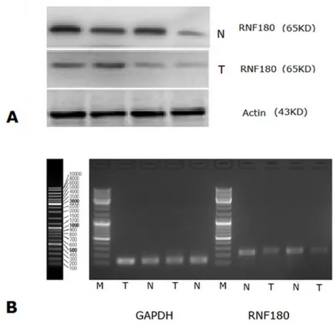 Fig. 3: MSP detection of RNF180 promoter methylation in different gastric cancer tissues and normal gastric mucosal tissues