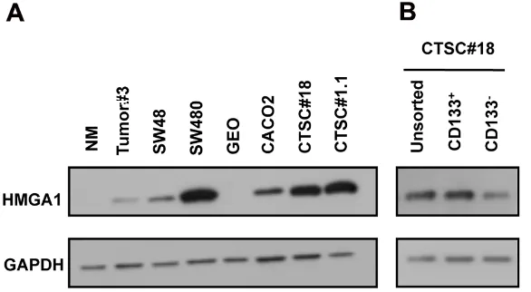 Figure 1: HMGA1 expression in CTSCs. A) Western blot for HMGA1 in normal colonic mucosa (NM), colon cancer sample Tumour#3, colon tumour-derived cell lines (SW48, SW480, GEO, and CACO3), and colon tumour stem cells (CTSC#18 and CTSC#1.1)