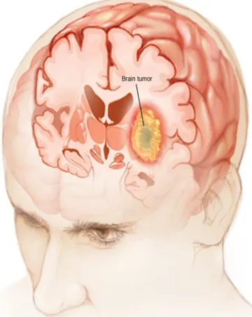 Fig. 1 Image of Brain Tumor [22] 