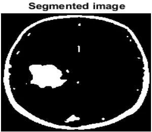Fig. 10 Image after Active Contour by Level Set 