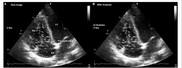 FIGURE 1 | Cardiac four-chamber view obtained by placing the probe at the level of the left fifth intercostal space