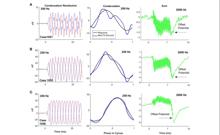 FIGURE 9 | Overshoot potential in some ANSD children reflected in the “sum” tracing. (A–C) Three different cases showing the offset overshoot