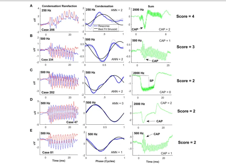 FIGURE 4 | ECochG examples of ANSD subjects with considerable evidence of neural activity
