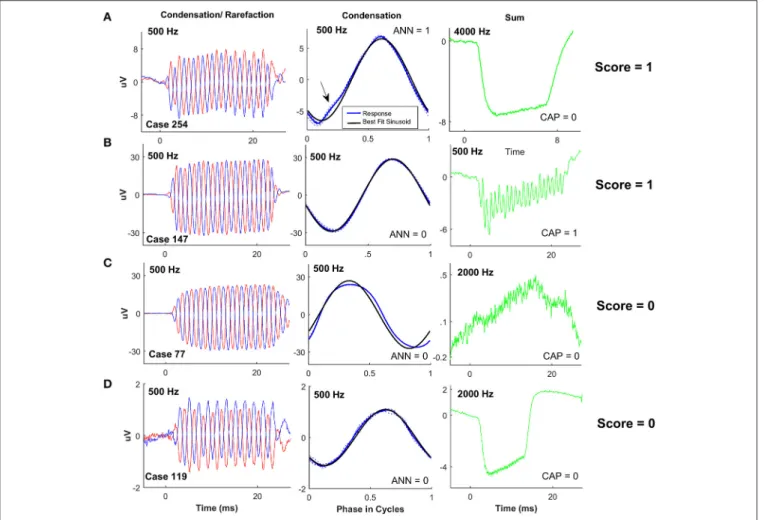 FIGURE 5 | ECochG examples with minimal neural activity. (A) A case with a nerve score of 1, showing a small ANN (arrow) and no CAP, and a large negative SP