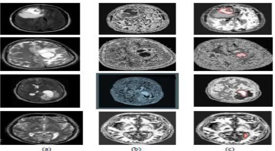 Fig -5: The collection of 30 mind tumor MRI picture 