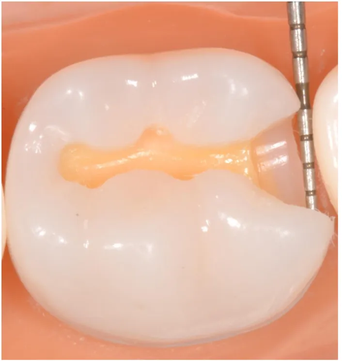 FIGURE 2.2- 3D model used to demonstrate clinically acceptable example of proximal  contact clearance  