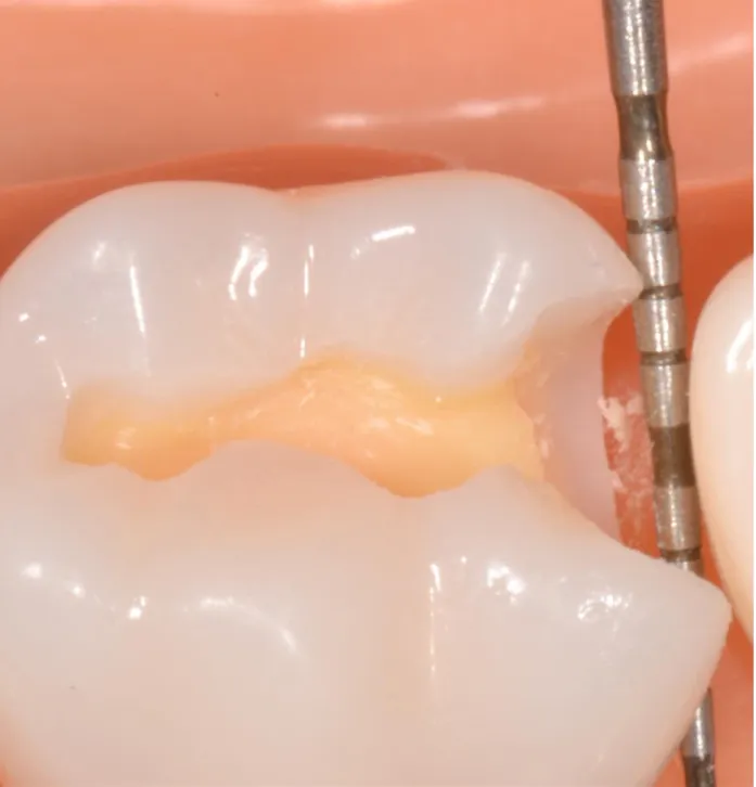 FIGURE 2.3- 3D model used to demonstrate clinically unacceptable example of proximal  contact clearance  