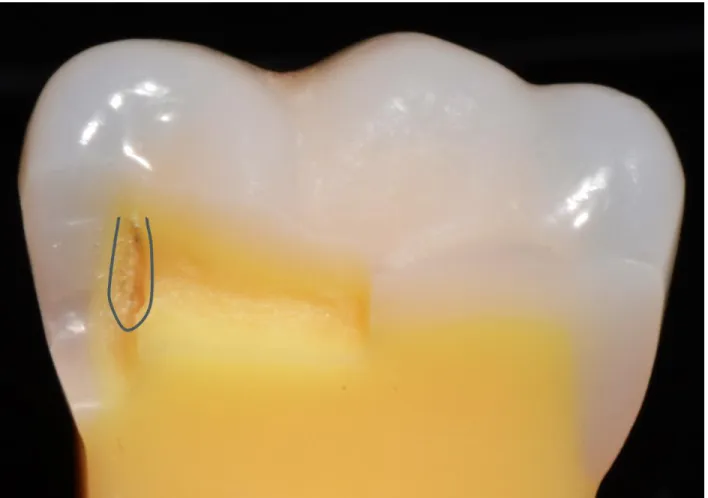 FIGURE 3.3- 3D model demonstrating clinically acceptable retention groove placement 