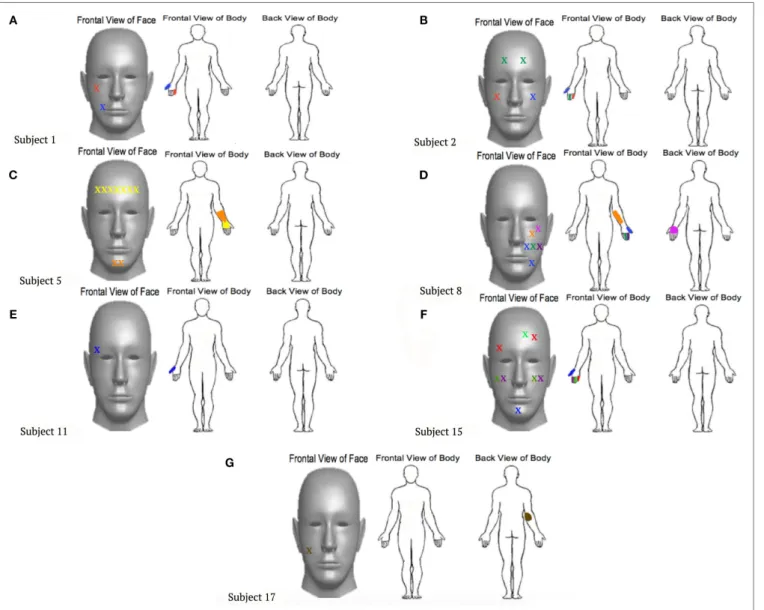 FigUre 1 | locations touched on the faces that were reported to also elicit sensations within the phantom limb
