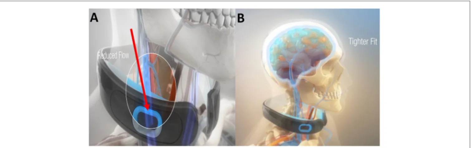 FigUre 1 | The Q-collar designed to facilitate the actions of the compressive effect of the omohyoids to reduce blood outflow of the brain (a) and  produce a tighter fit of the brain within the cranium (B).