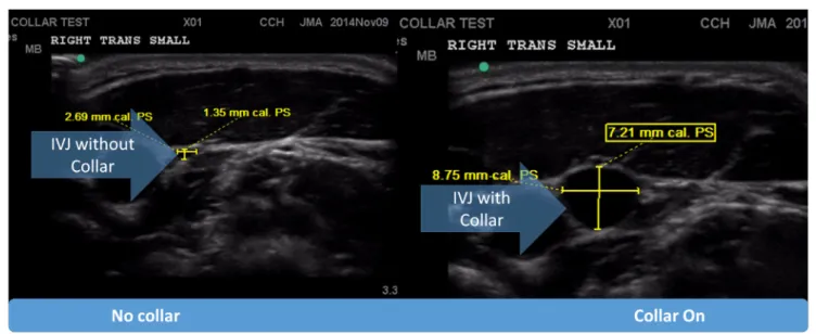 FigUre 3 | Pictorial representation of internal jugular vein (iJV) response via dilation to the application of the collar device.